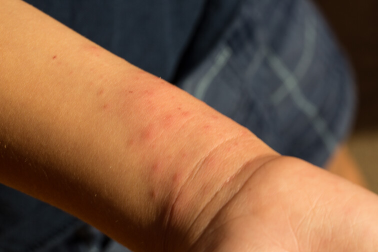 Piqures de punaises de lit